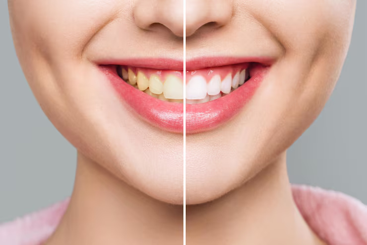 Teeth Whitening