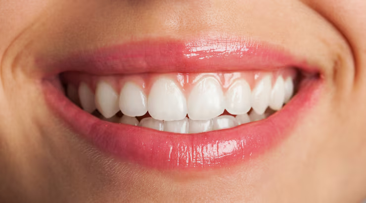 Dental Veneers